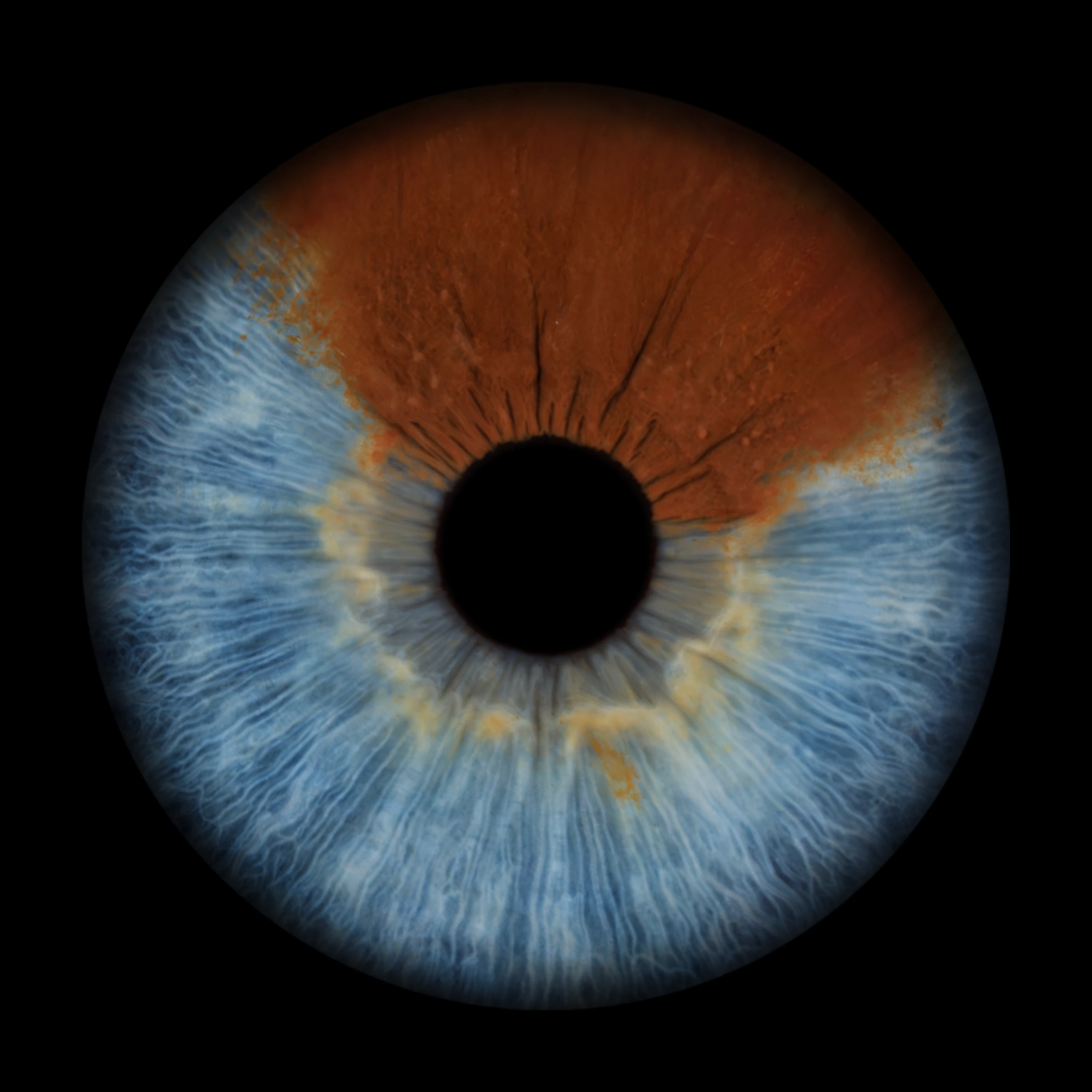 Heterochromia Iris